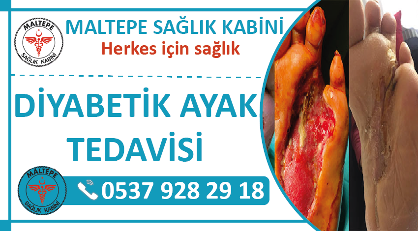 Diyabetik Ayak Tedavisi Hizmeti sunan sağlık kabini ve Diyabetik Ayak Bakımı Hemşire